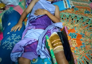 Anak Berusia 11 Tahun di Desa Kuala Alam Butuh Uluran Tangan, RK Mengalami Patah Tulang Paha Akibat Laka Lantas