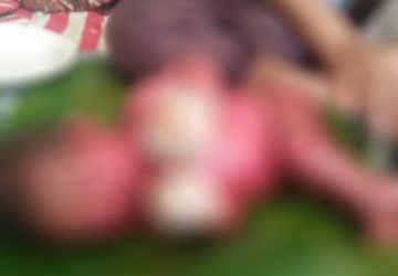 Bayi Lahir Kondisi Kulit Mengering dan Memerah di Desa Baru Dirujuk ke RS Umum Bangkinang