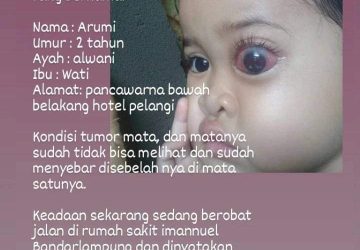 Mengidap Tumor Pada Mata, Arumi Balita 2 Tahun Asal Kuripan Kotaagung Butuh Uluran Tangan
